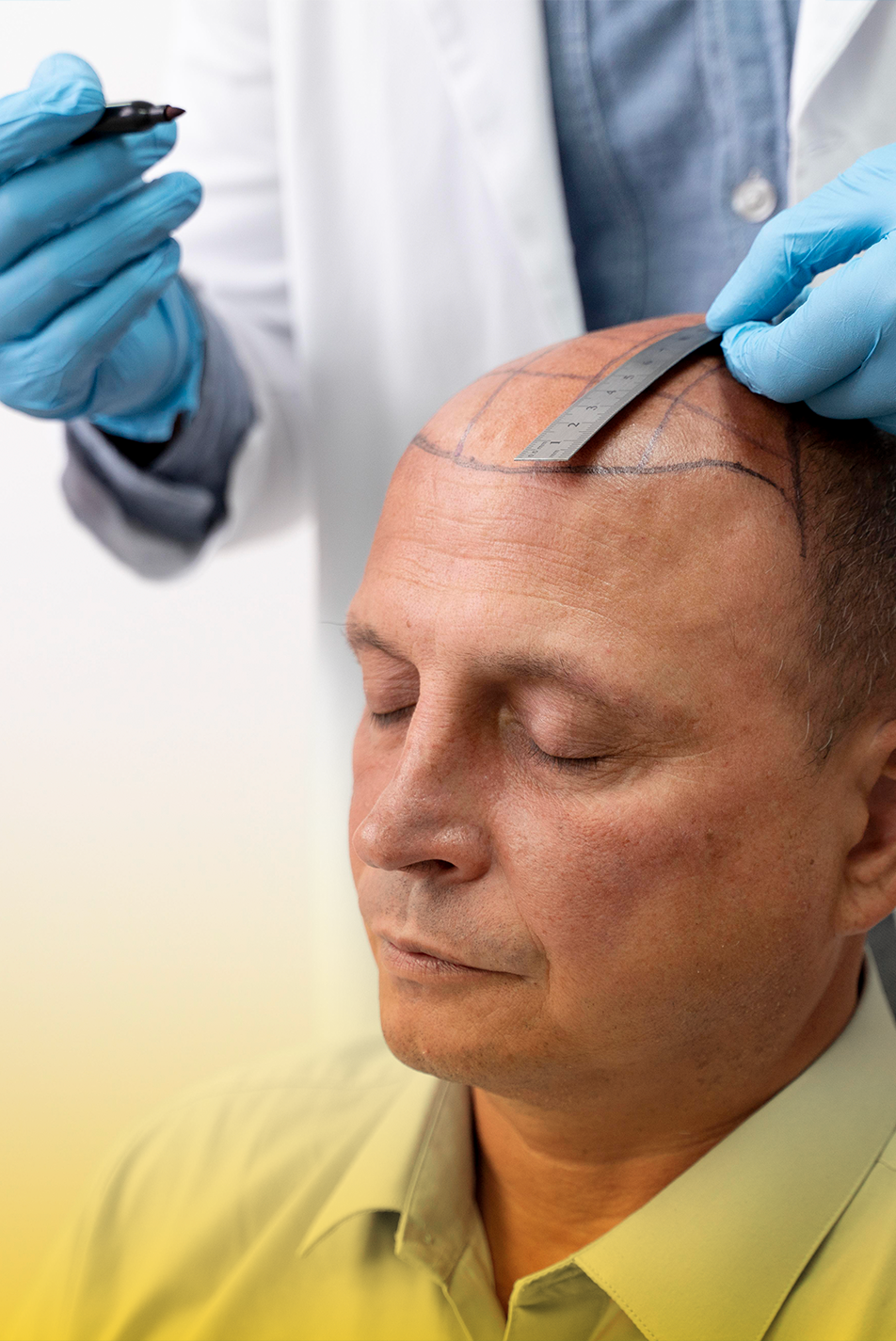 Tratamiento de Micro implante capilar en hombres y mujeres en Medellín. Tratamiento contra la alopecia y caída del cabello con resultados naturales y a largo plazo