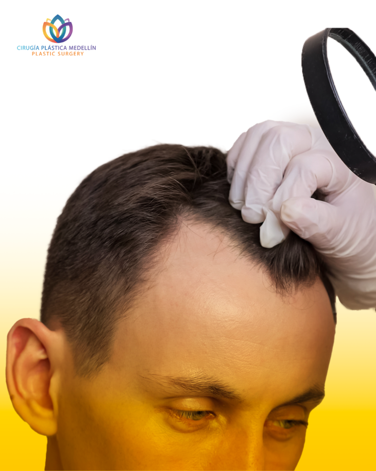 Tratamiento de Micro implante capilar en hombres y mujeres en Medellín. Tratamiento contra la alopecia y caída del cabello con resultados naturales y a largo plazo