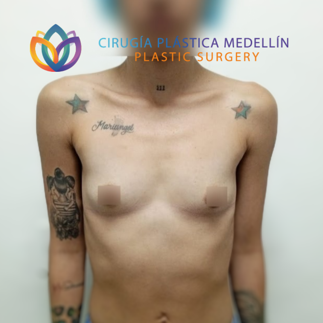 La Transformación de Daniela Castañeda Posso con Mamoplastia de Aumento