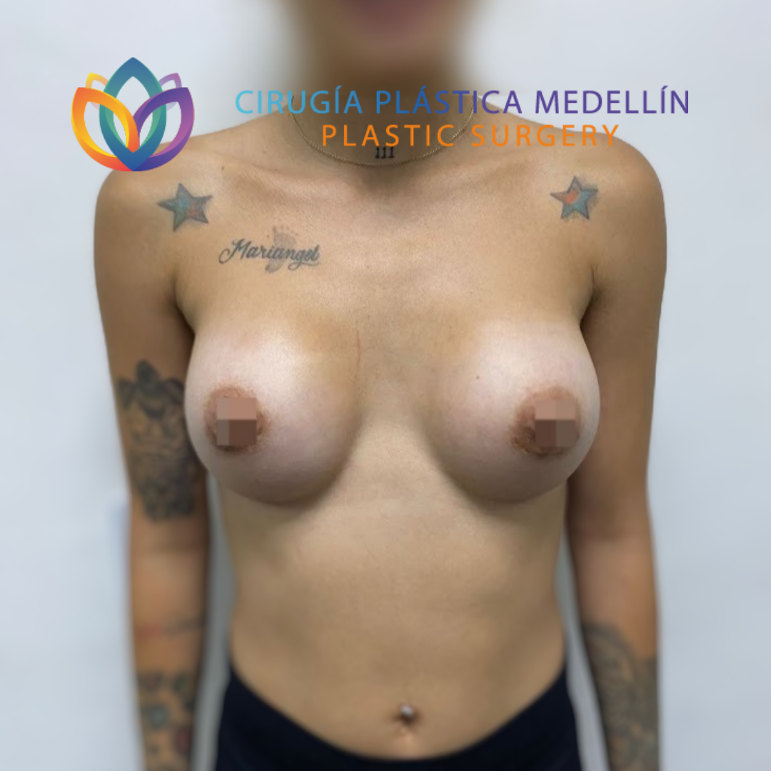 La Transformación de Daniela Castañeda Posso con Mamoplastia de Aumento