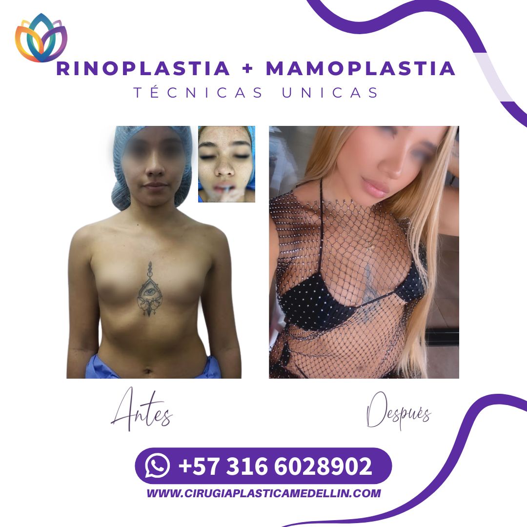 Mamoplastia de Aumento con Técnica de cuñas