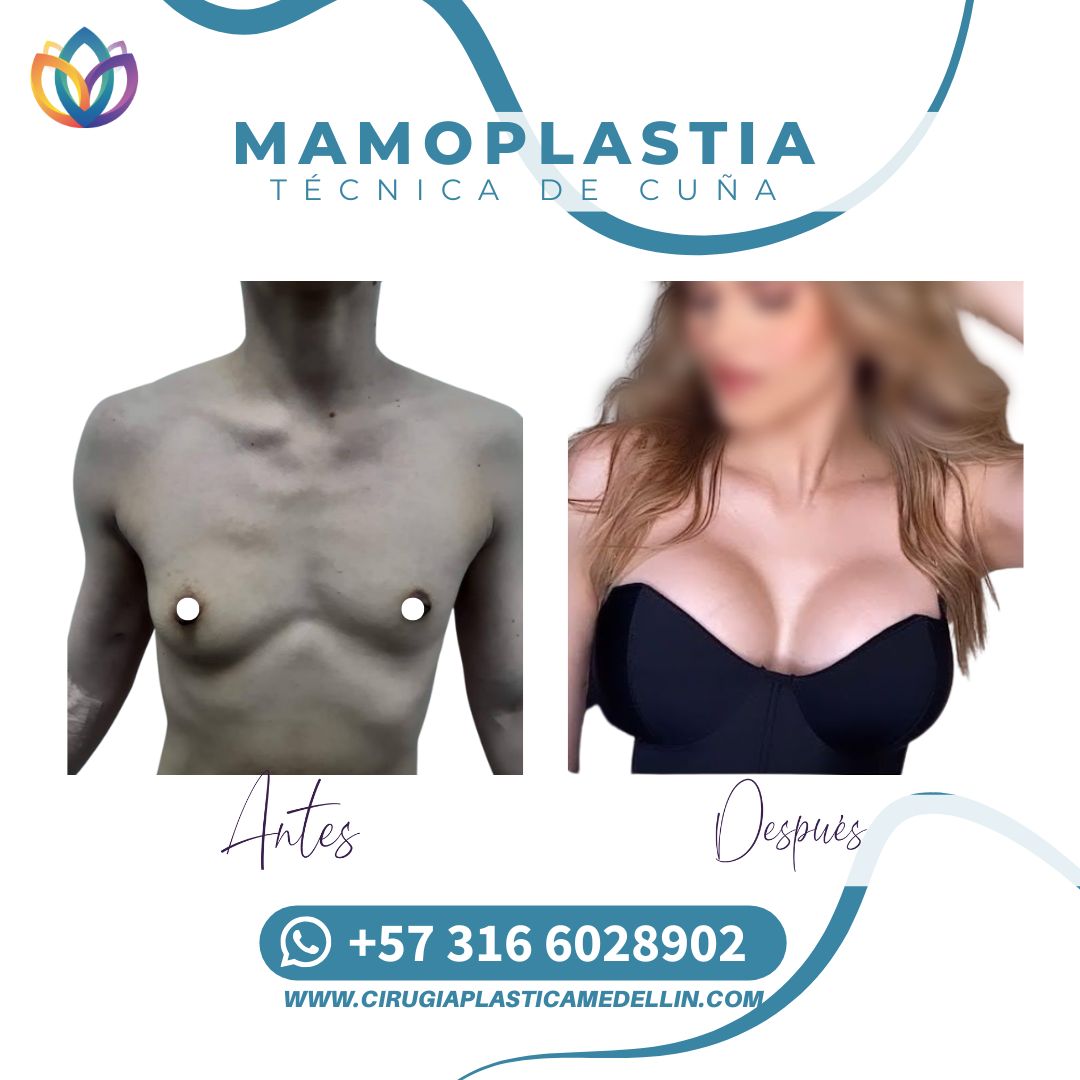 Mamoplastia de Aumento con Técnica de cuñas