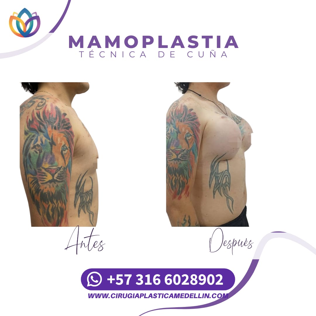Mamoplastia de Aumento mujer trans