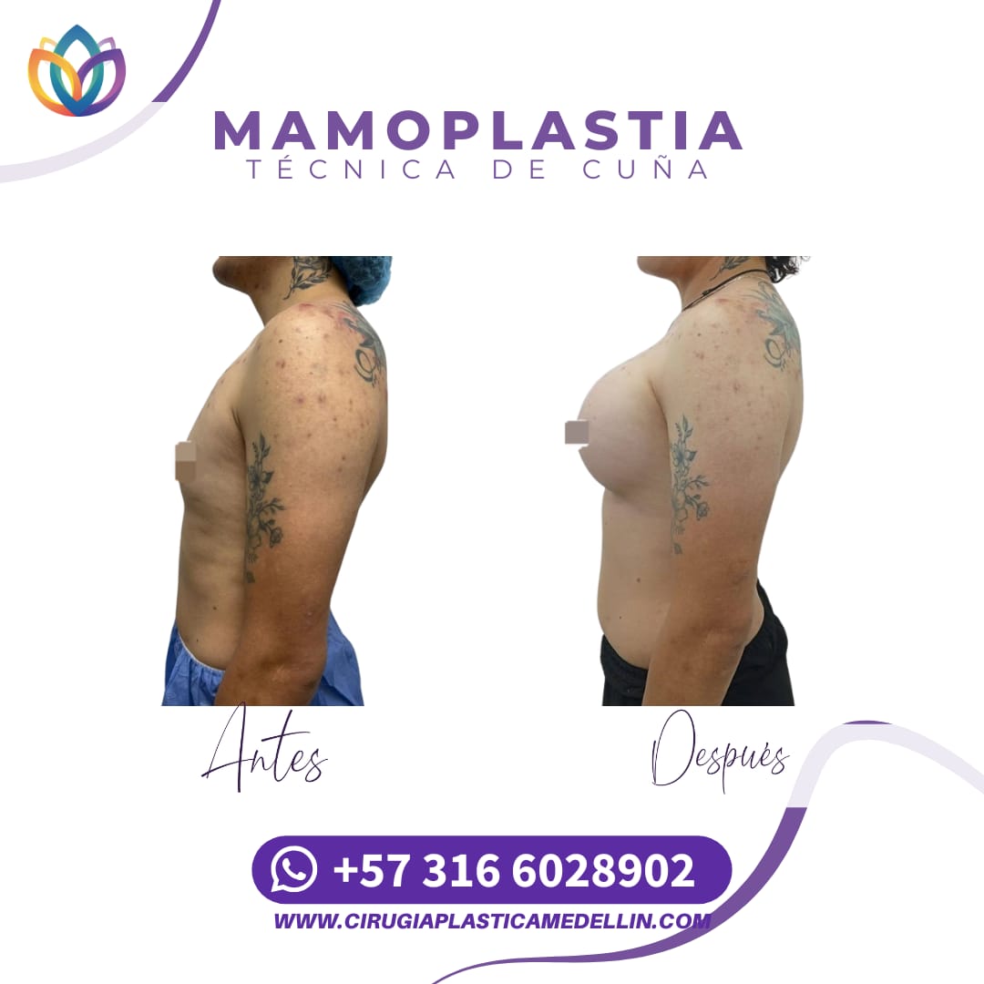 Mamoplastia de Aumento mujer trans
