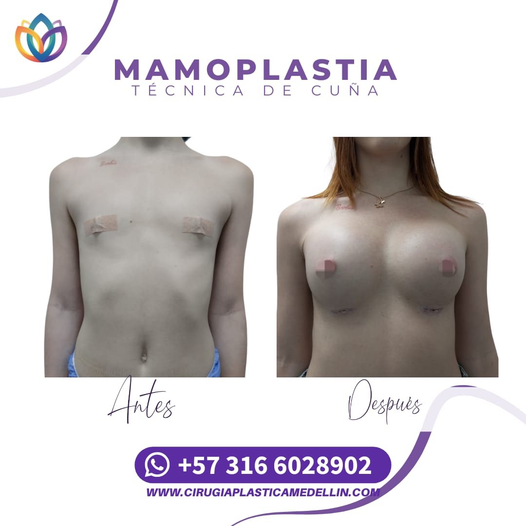 Mamoplastia de Aumento mujer trans