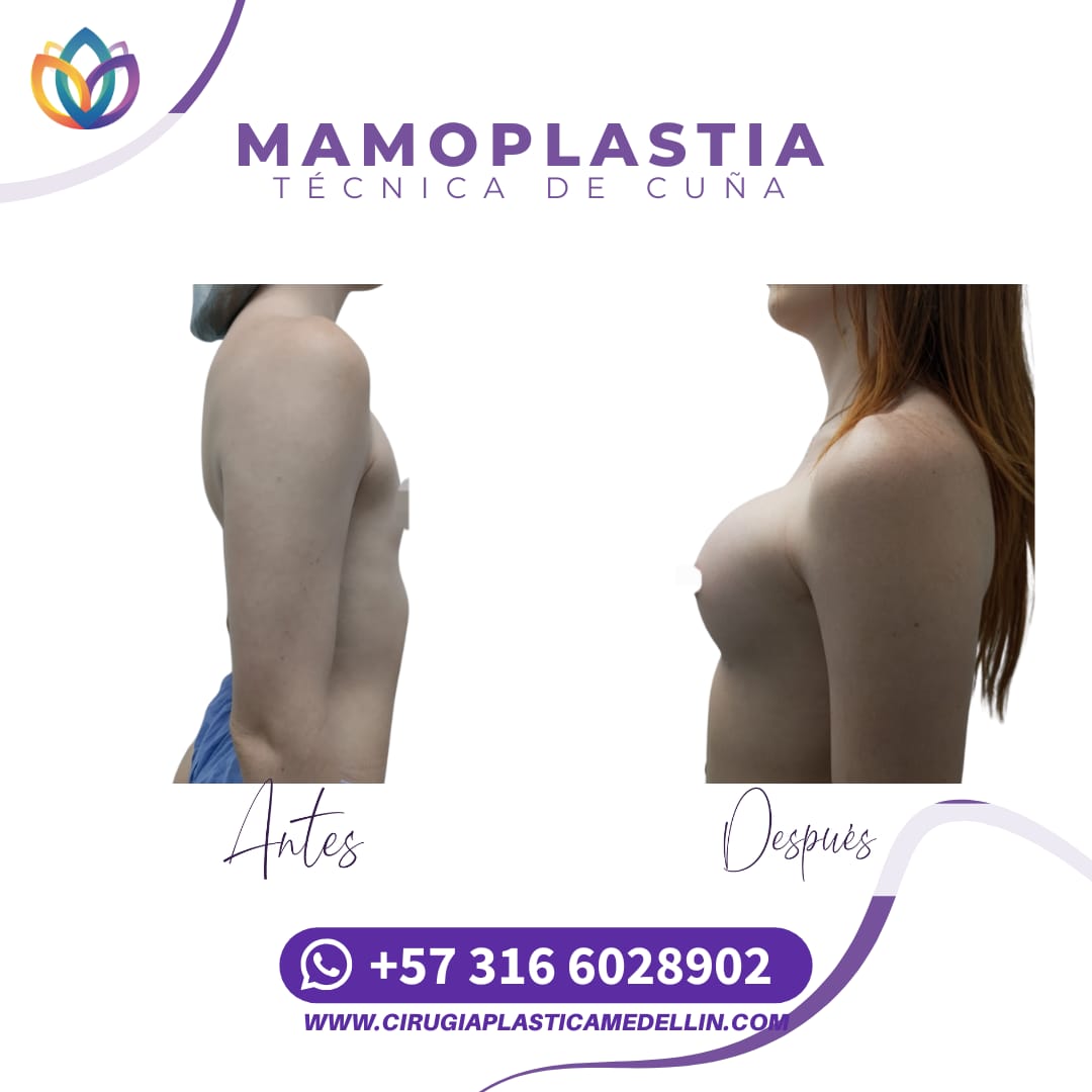 Mamoplastia de Aumento mujer trans