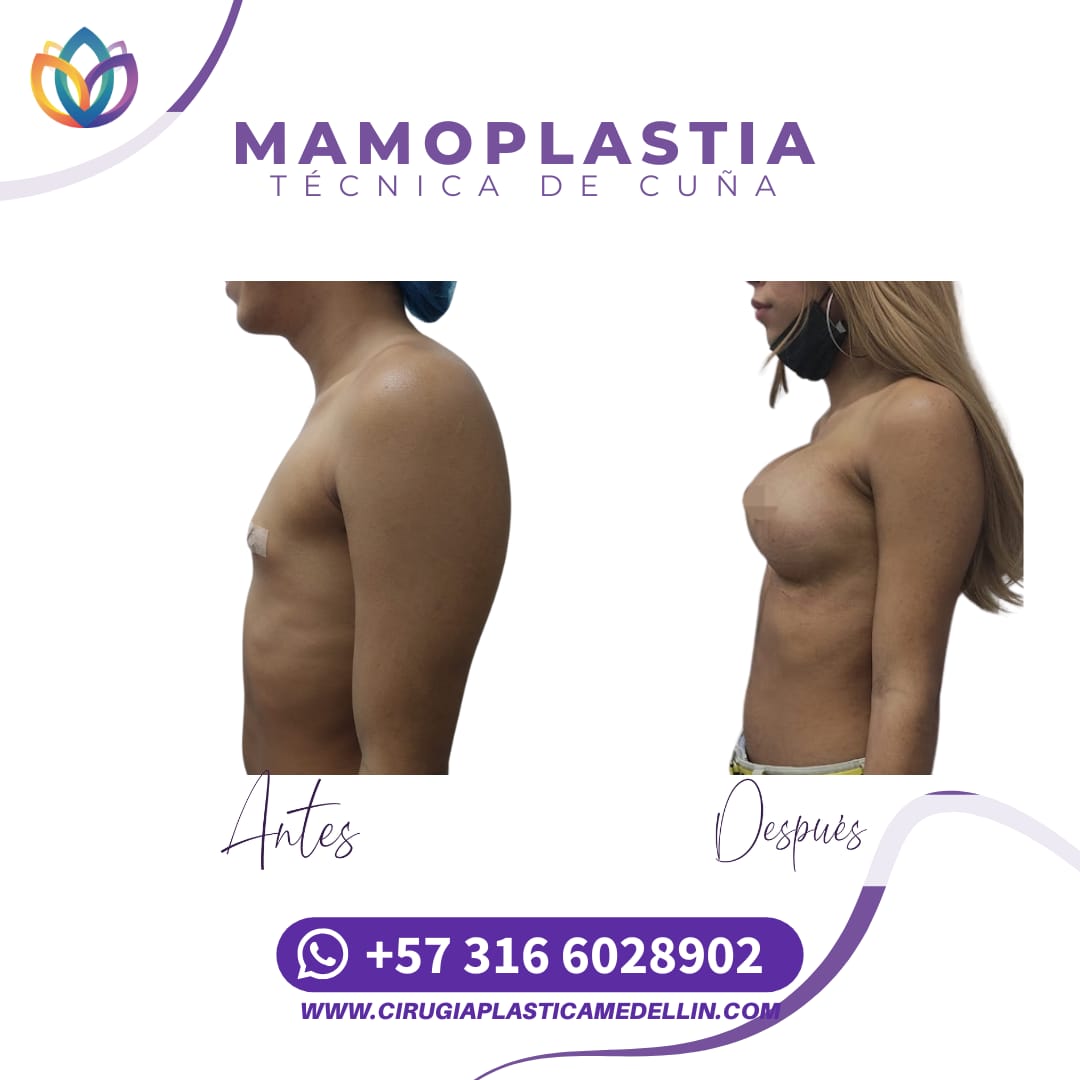 Mamoplastia de Aumento mujer trans