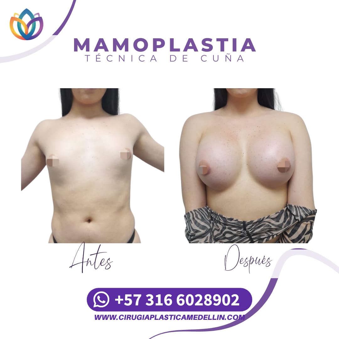 Mamoplastia de Aumento mujer trans
