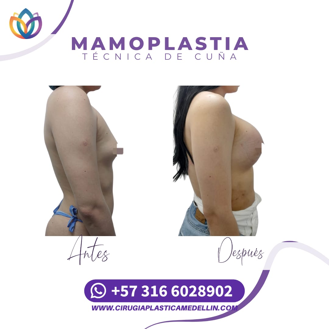 Mamoplastia de Aumento mujer trans