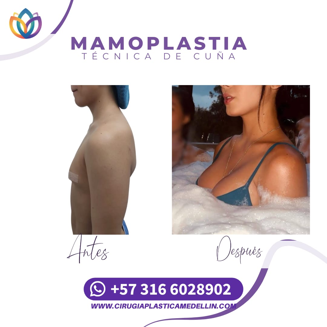 Mamoplastia de Aumento mujer trans