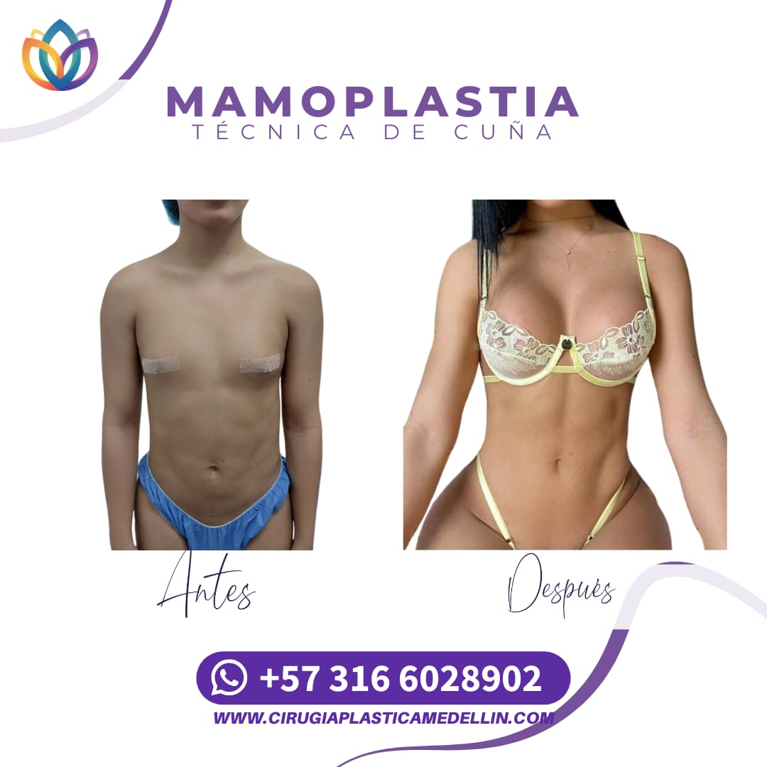 Mamoplastia de Aumento mujer trans