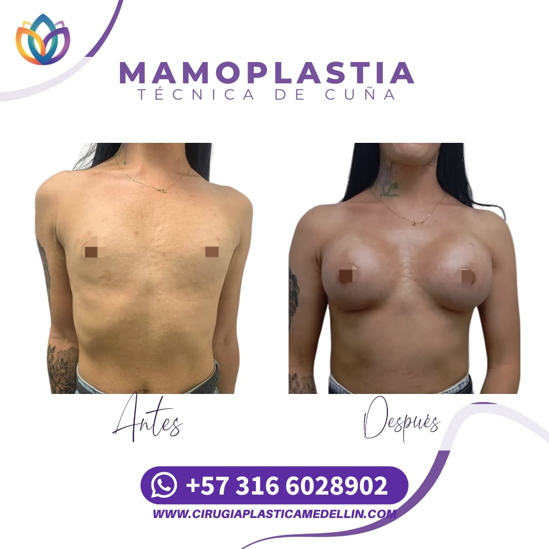 Mamoplastia de Aumento mujer trans
