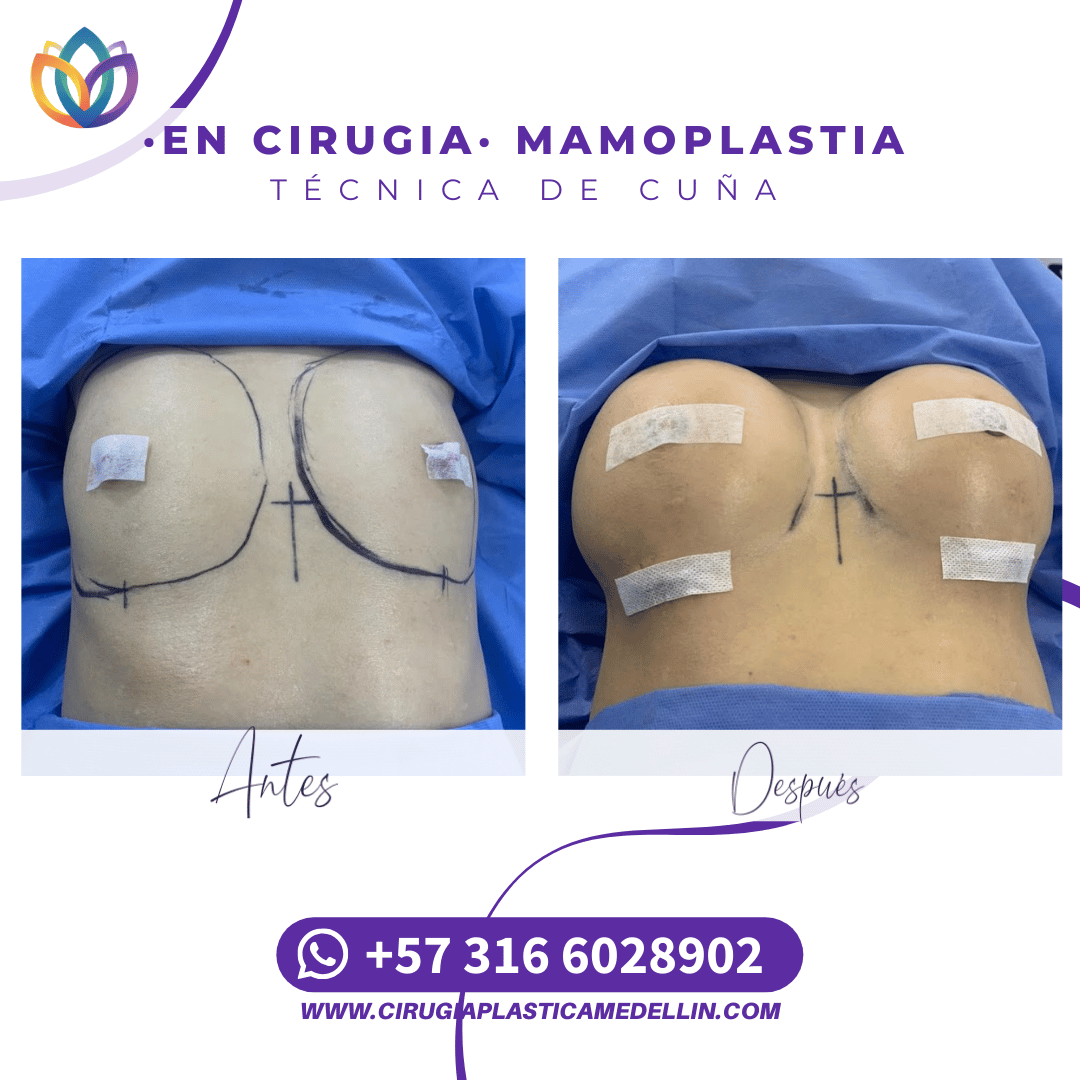 Mamoplastia Medellin