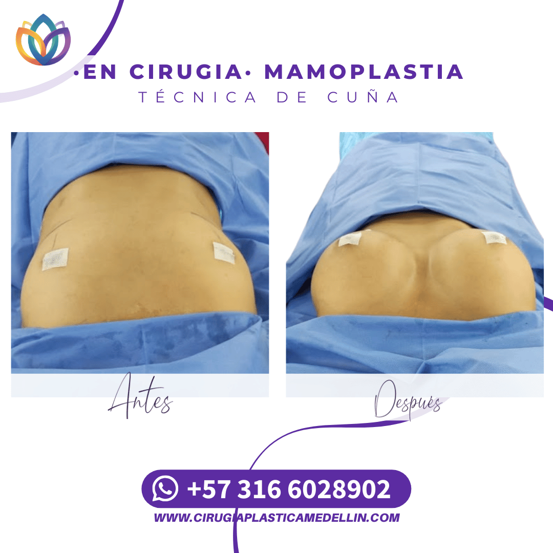 Mamoplastia Medellin