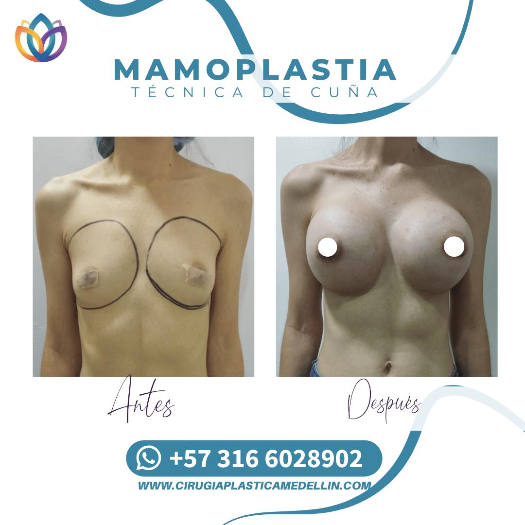 Mamoplastia Medellin