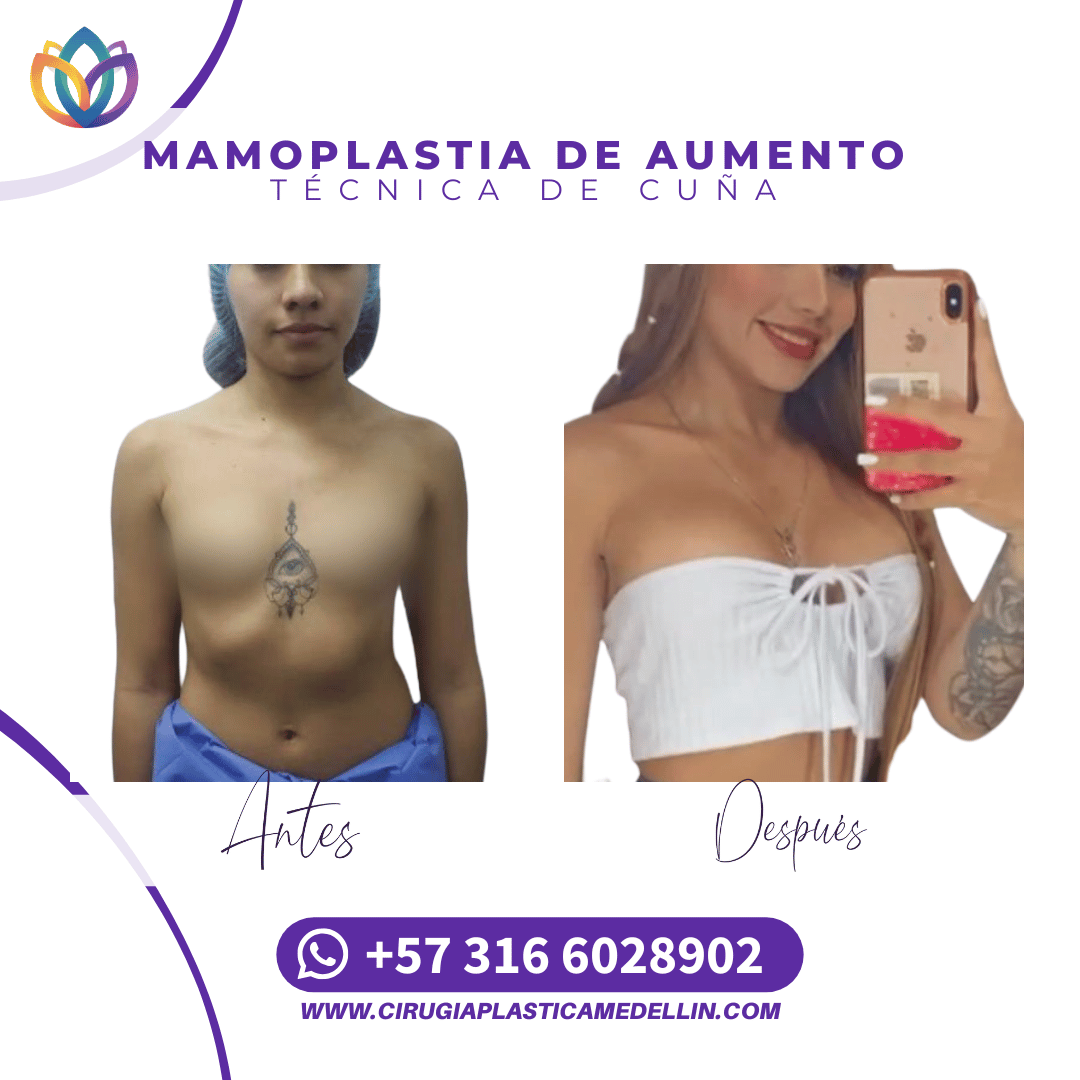 Mamoplastia Medellin
