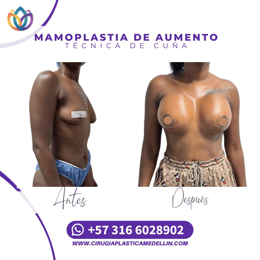 Mamoplastia Medellin