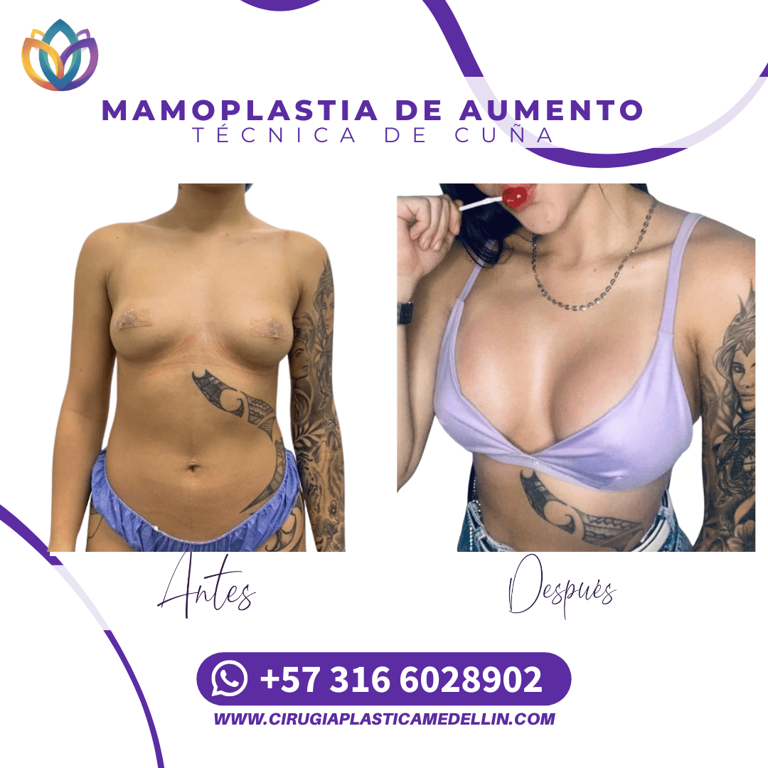 Mamoplastia Medellin