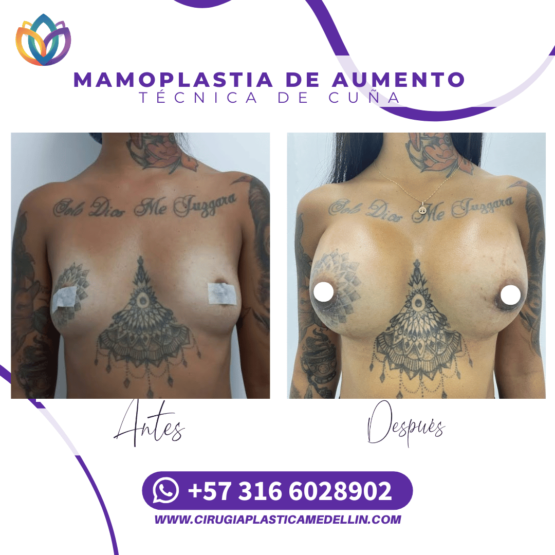 Mamoplastia Medellin