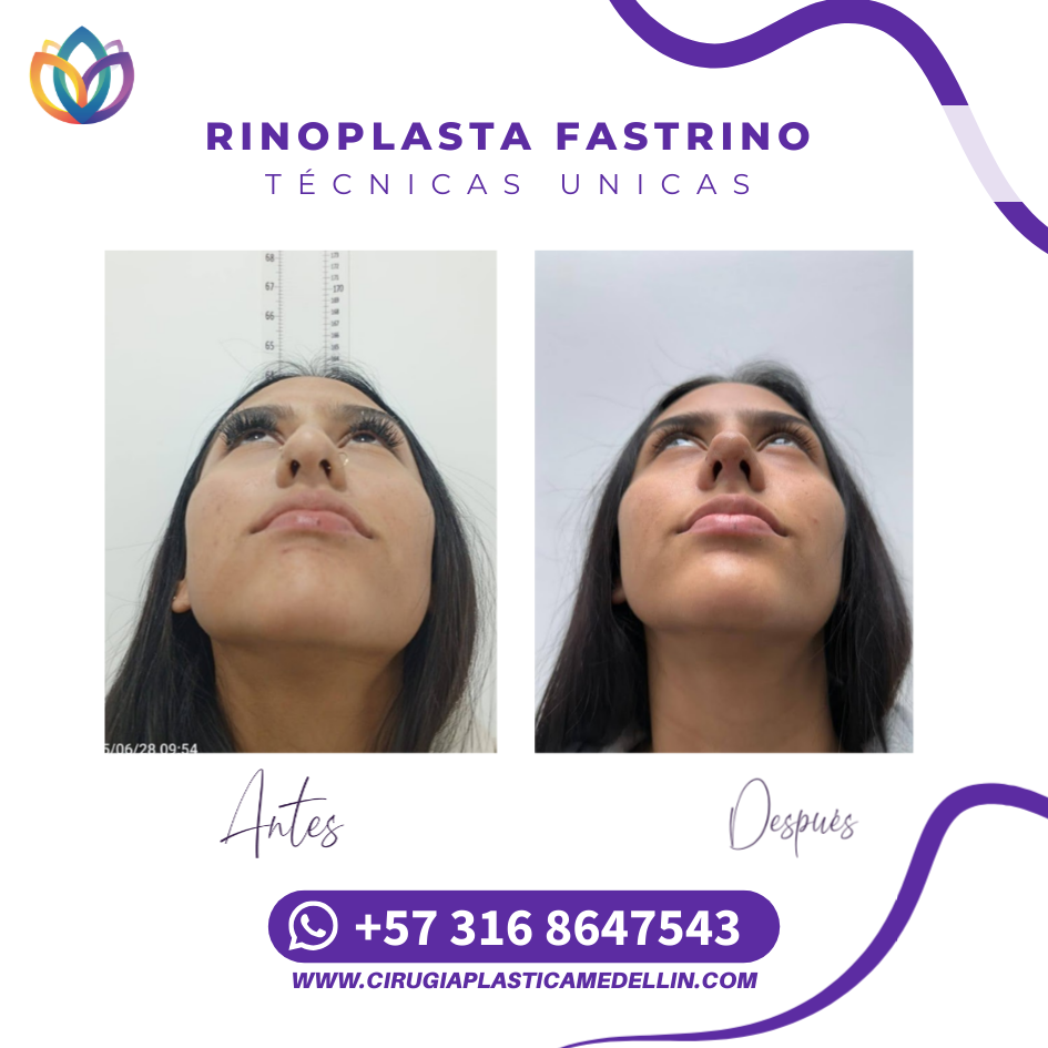 Rinoplastia en Medellín con resultados naturales