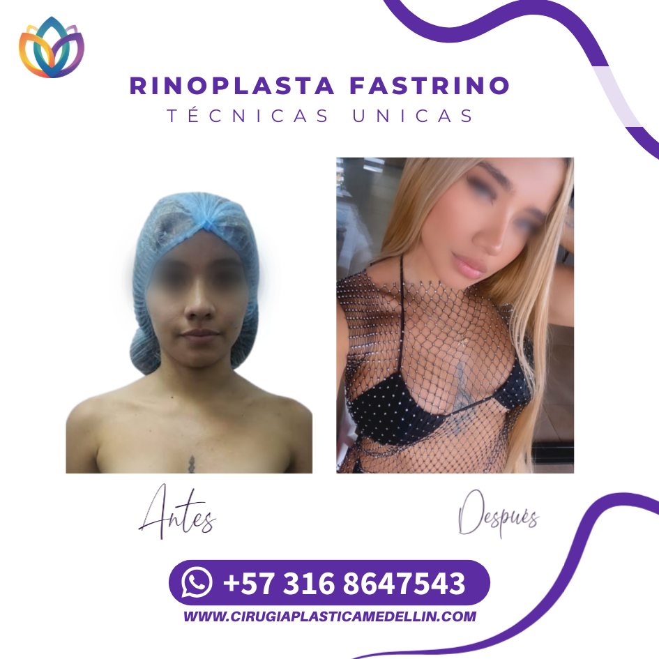 Rinoplastia estética en Medellín precio especial