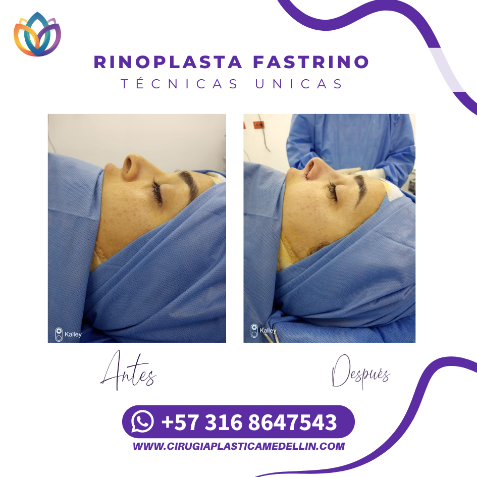 Antes y después rinoplastia Medellín