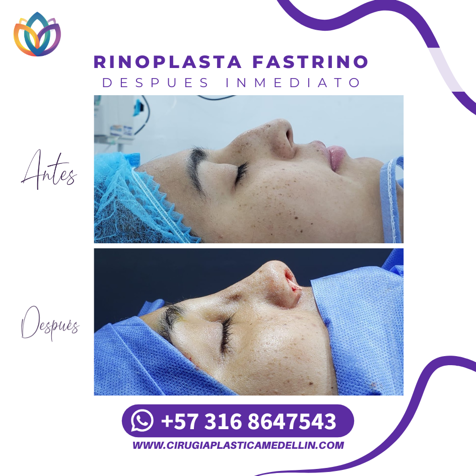 Rinoplastia funcional en Medellín para rinitis