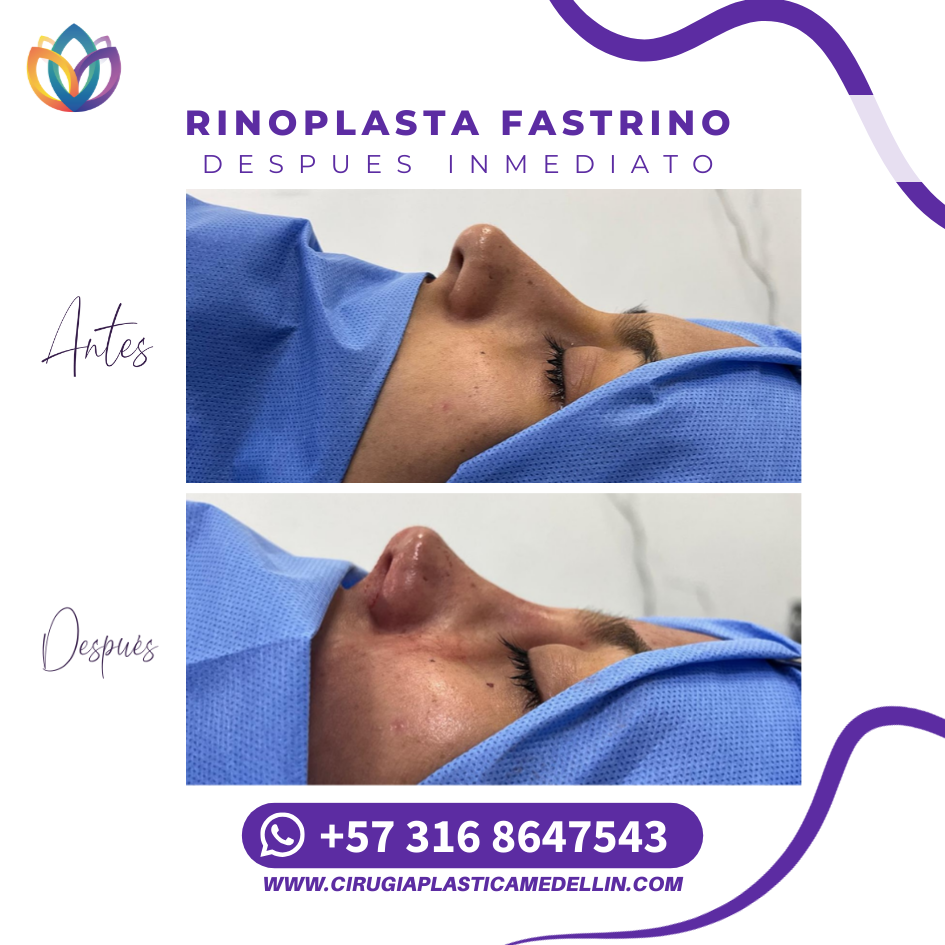 Cirugía plástica de nariz Medellín testimonio paciente