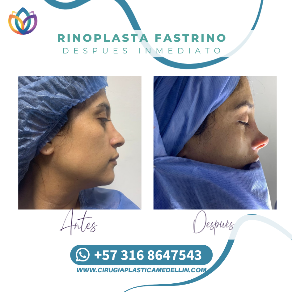 Rinoplastia Medellín cirujano plástico certificado