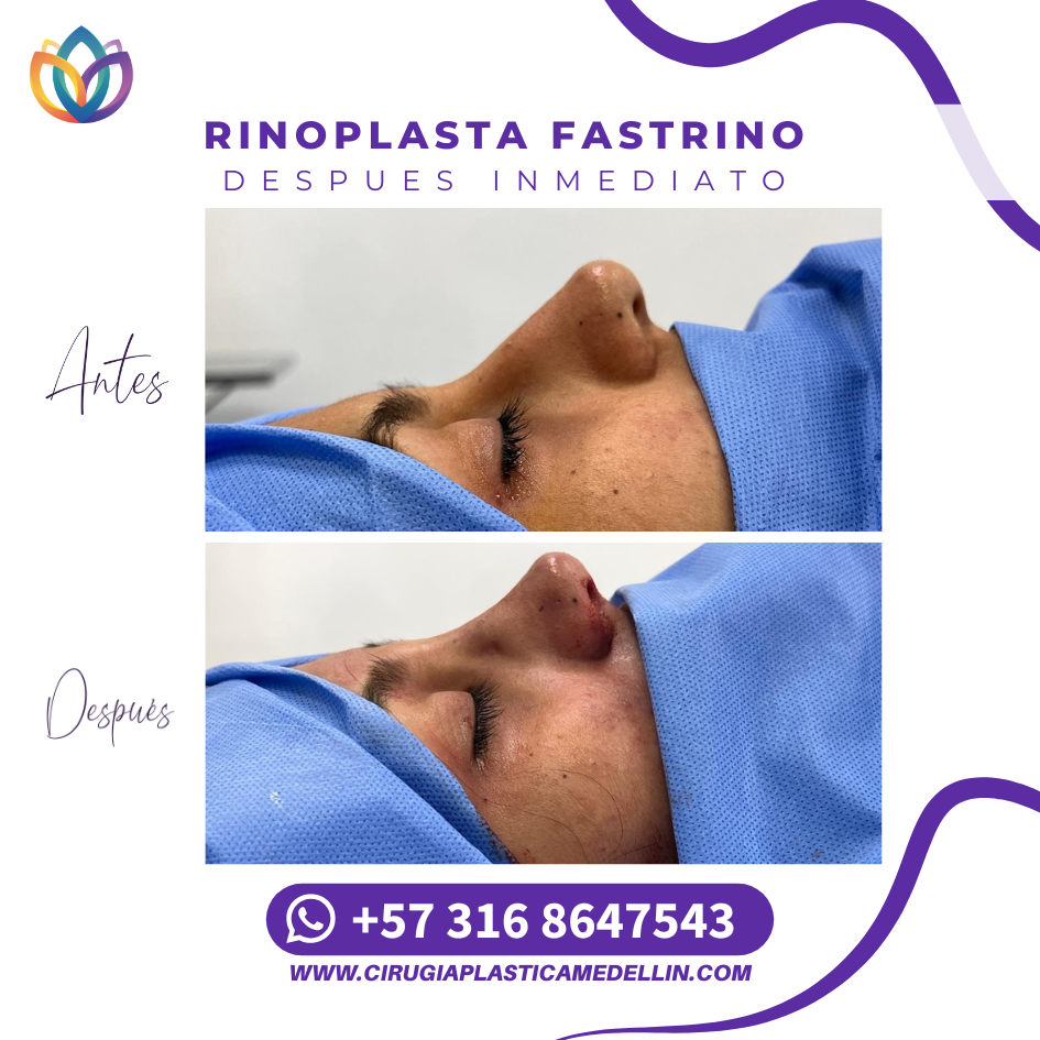Rinoplastia en Medellín paquetes quirúrgicos completos