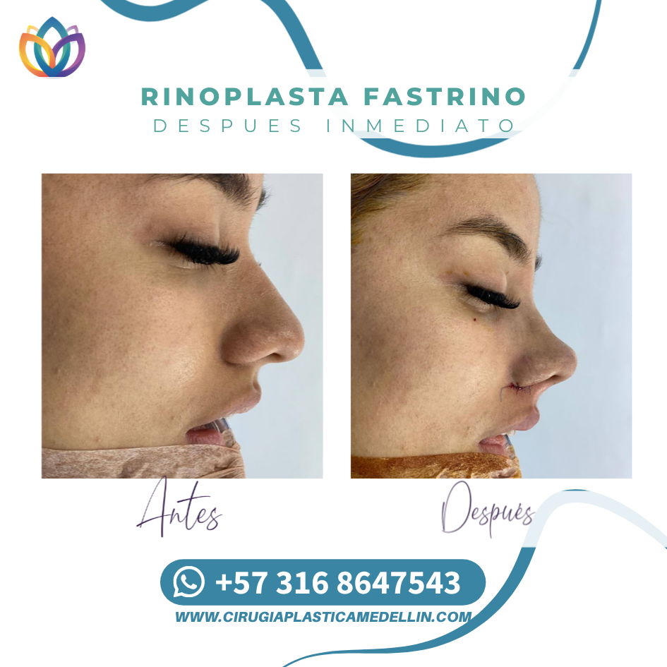Resultado rinoplastia natural Medellín