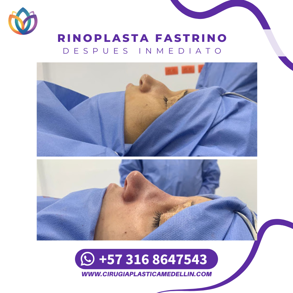 Promoción rinoplastia Medellín septiembre