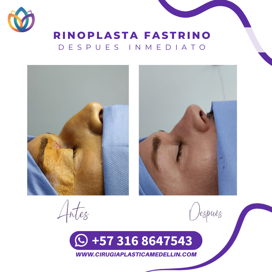 Rinoplastia en Medellín experiencia internacional