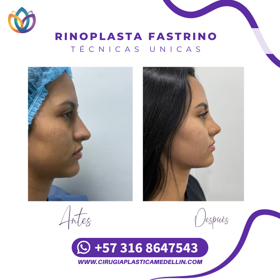 Rinoplastia para perfil armónico Medellín