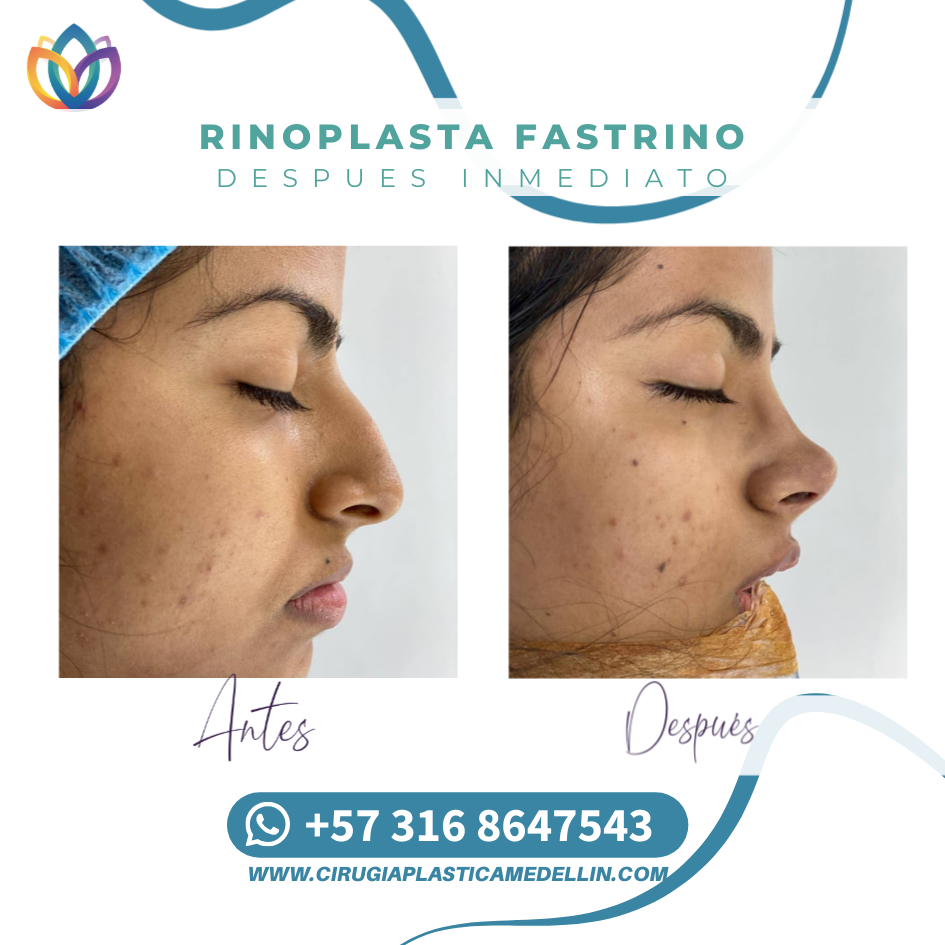 Cirugía de nariz Medellín testimonios reales