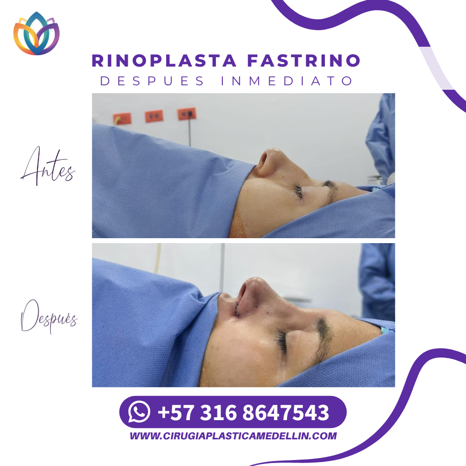 Rinoplastia natural y funcional Medellín