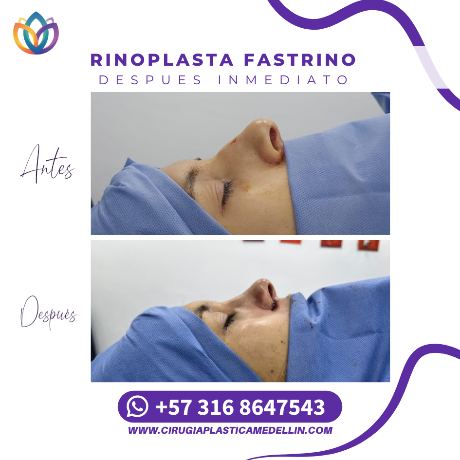 Rinoplastia Medellín antes después