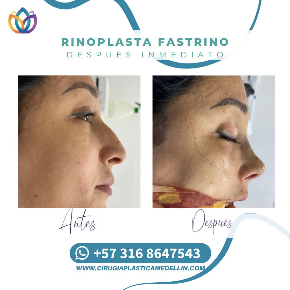 Cirugía estética de nariz Medellín promoción