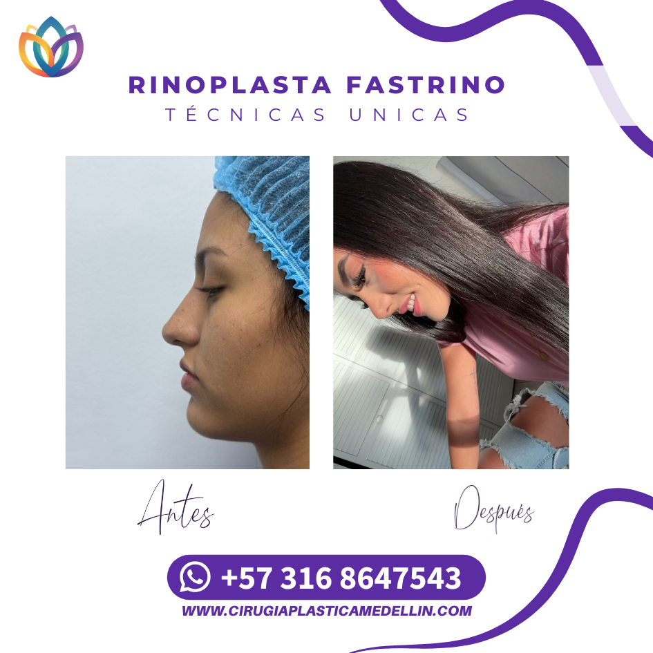 Rinoplastia armónica Medellín cirugía plástica
