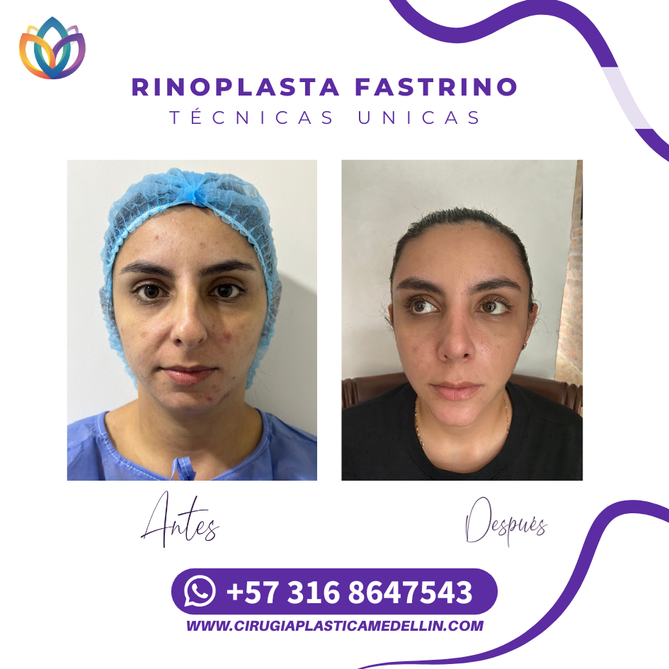 Rinoplastia profesional Medellín clínica especializada