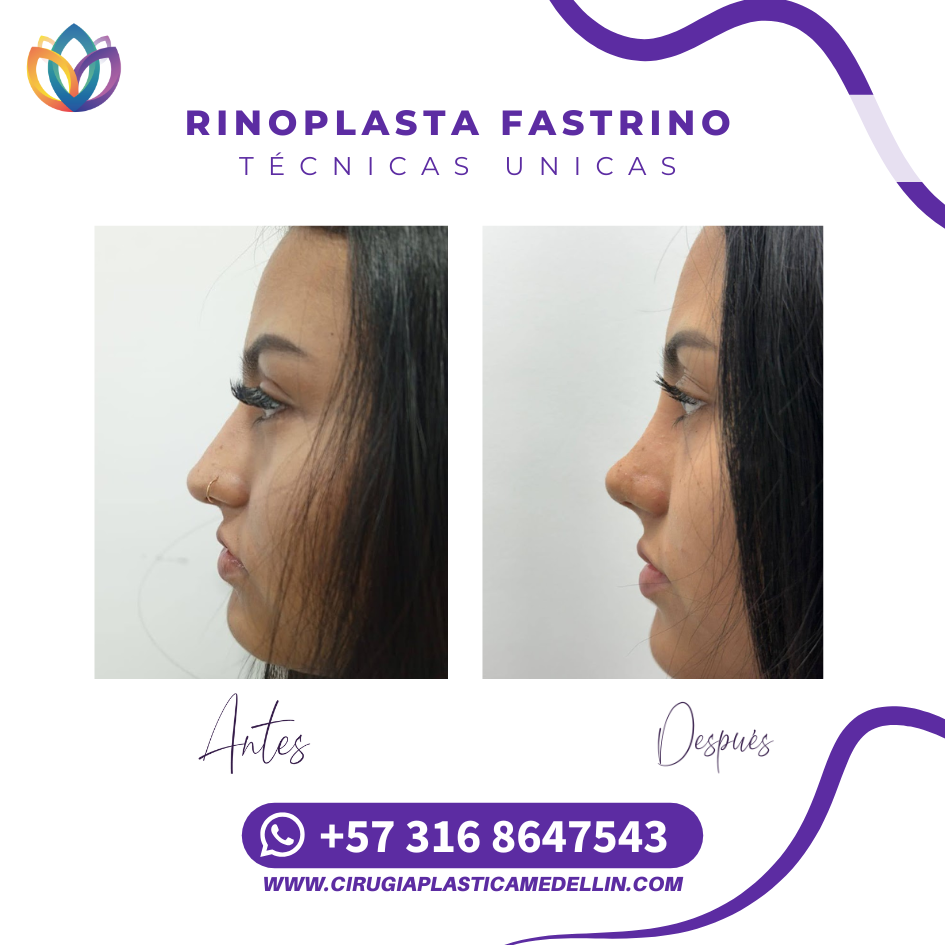 Resultados rinoplastia Medellín paciente real