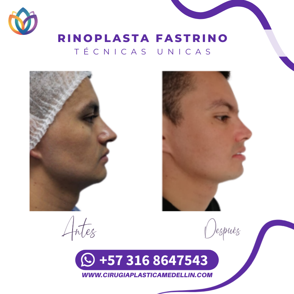 Rinoplastia con cirujano plástico Medellín