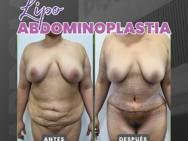 Lipoabdominoplastia en Medellín: el proceso de Natalia Novoa para volver a confiar en una cirugía